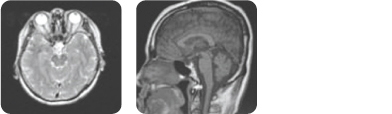 두경부 검사 MRI