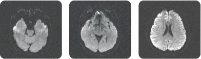 뇌확산 강조영상 검사 MRI