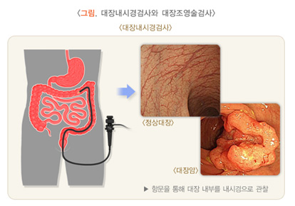 그림, 대장내시경검사와 대장조형술검사