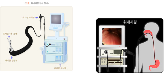 그림,위내시경 검사 장비