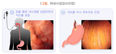 그림,위내시경검사과정