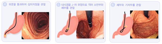 그림,위내시경검사과정