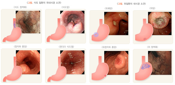 그림, 위내시경 소견