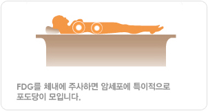 FDG를 체내에 주사하면 암세포에 특이적으로 포도당이 모입니다.