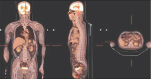 PET-CT 정상 영상