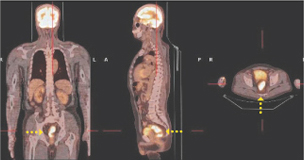 PET-CT 직장암 영상