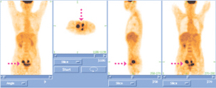 PET-CT 난소암 영상
