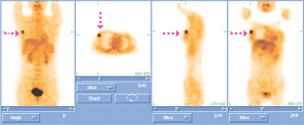 PET-CT 유방암 영상