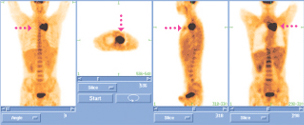 PET-CT 폐암 영상