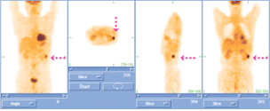 PET-CT 신장암 영상