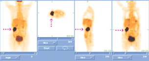 PET-CT 대장암 영상